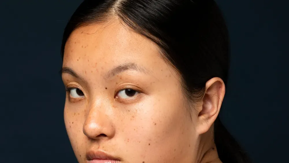 Sun Protection Tips for Preventing Melasma and Hyperpigmentation