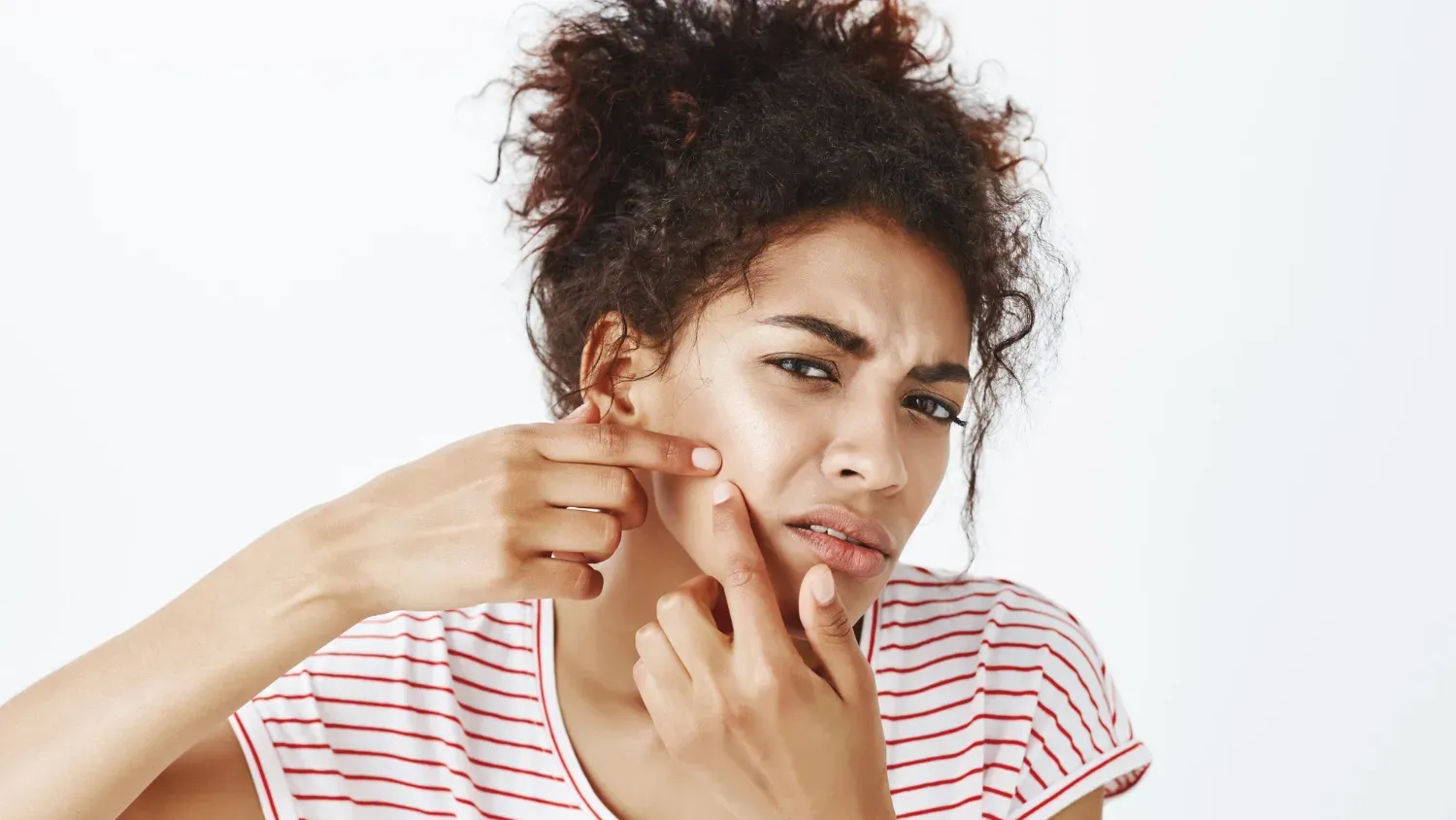 Why Acne Occurs During Periods: Causes, Treatment, and Prevention