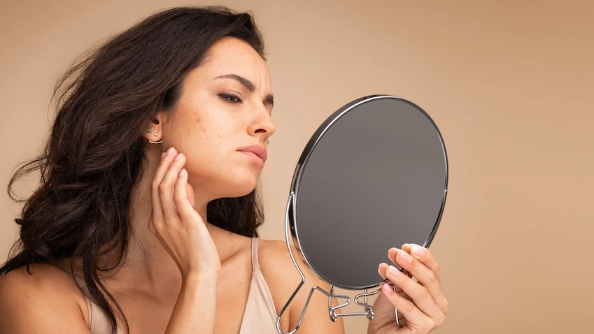 Moisture Solutions: How to Combat Dry Skin from Retinol Use