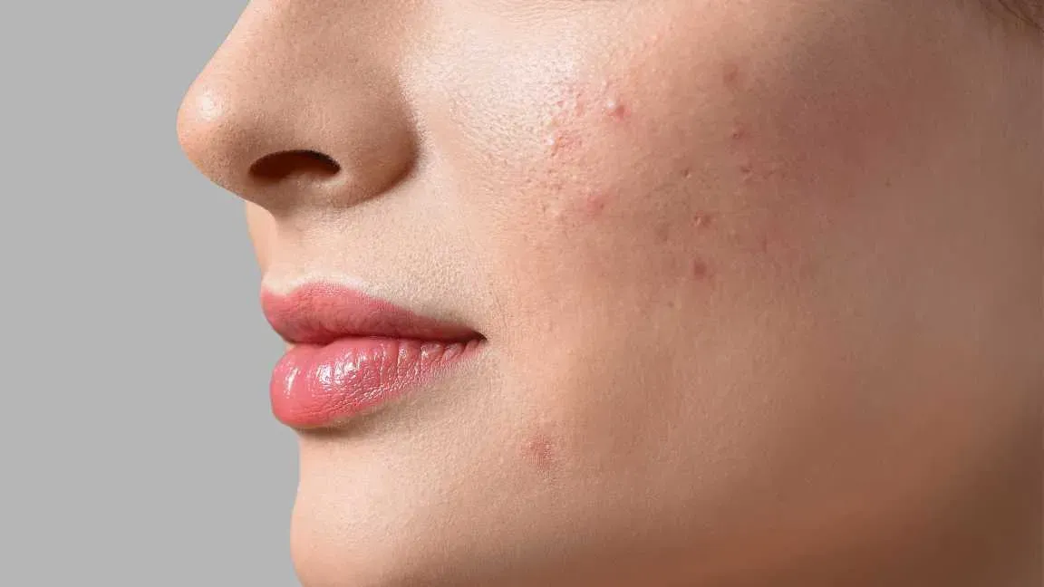 Unlock Clear Skin: Understanding Dendriclear and Acne