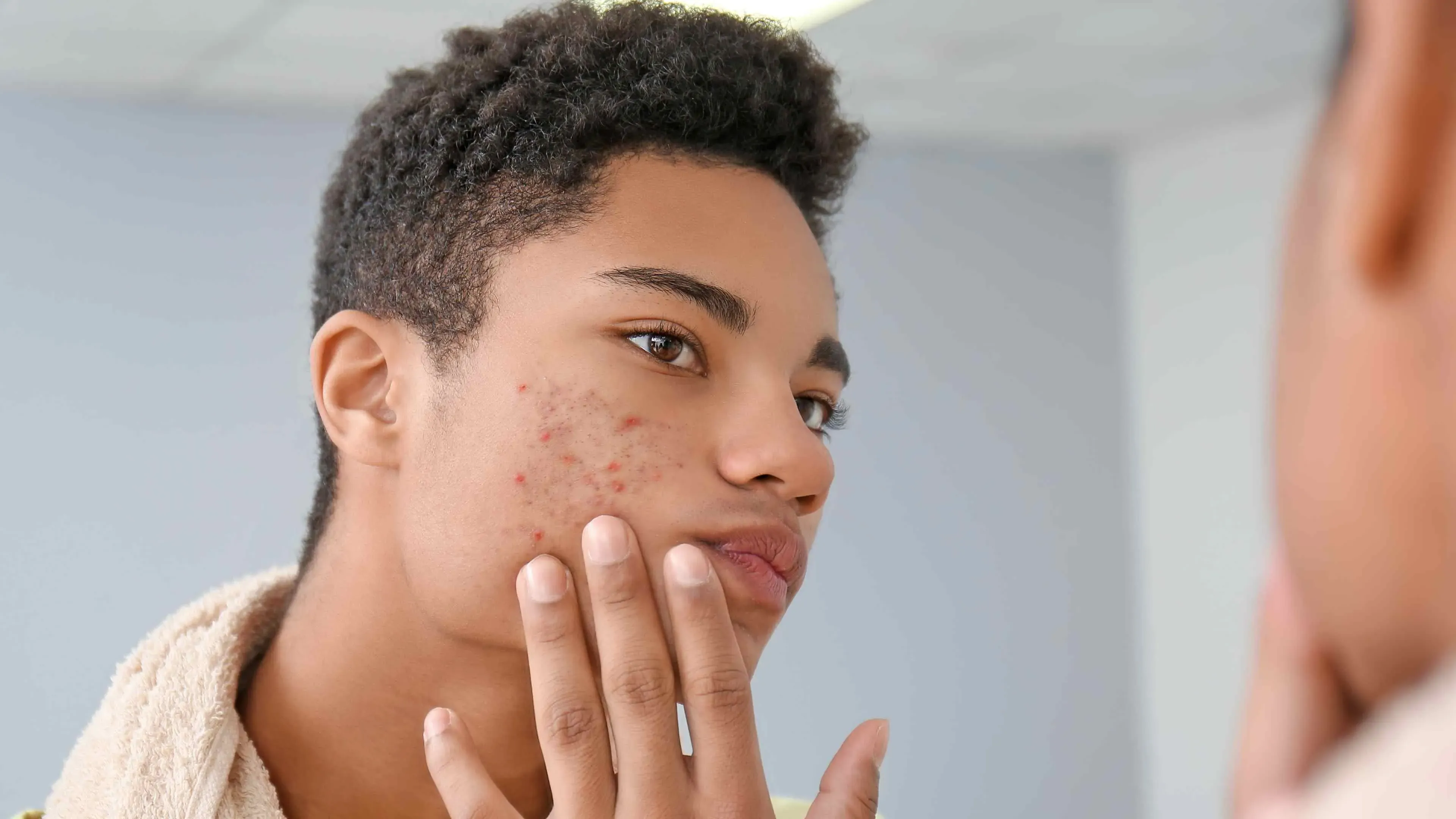 Understanding Acne Scars and Hyperpigmentation