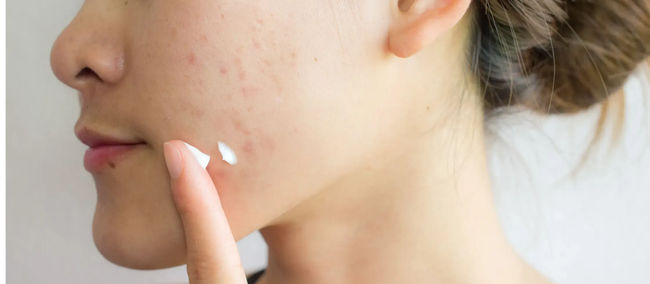 Essential Sunscreen Tips for Oily, Acne-Prone Skin