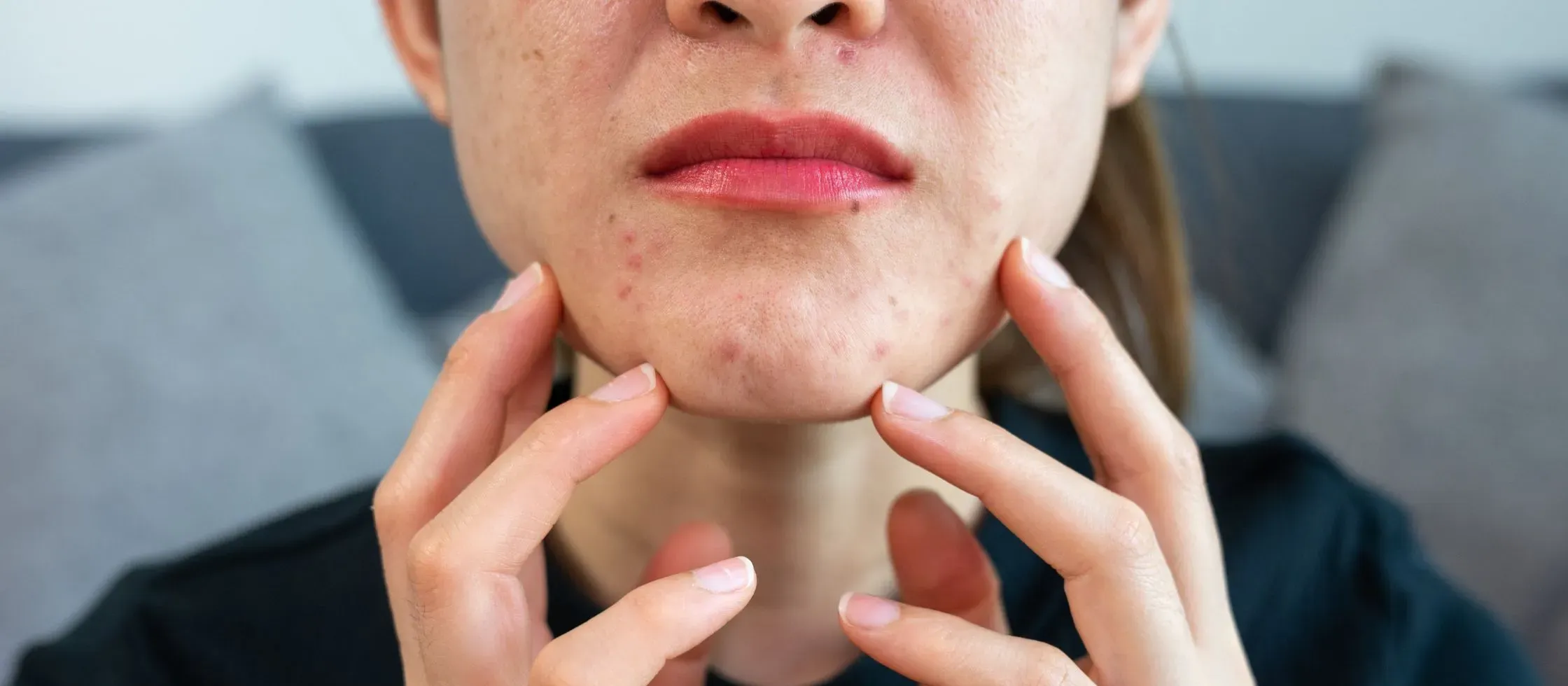 Is Anti-Acne Serum Good? Discover the Benefits