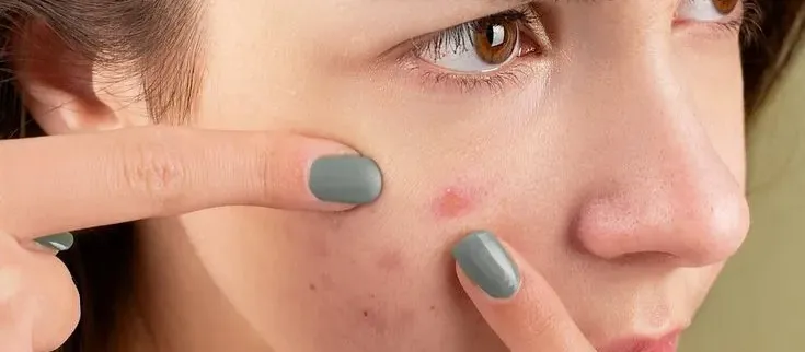Effective Ways to Remove Pimples and Dark Spots Permanently