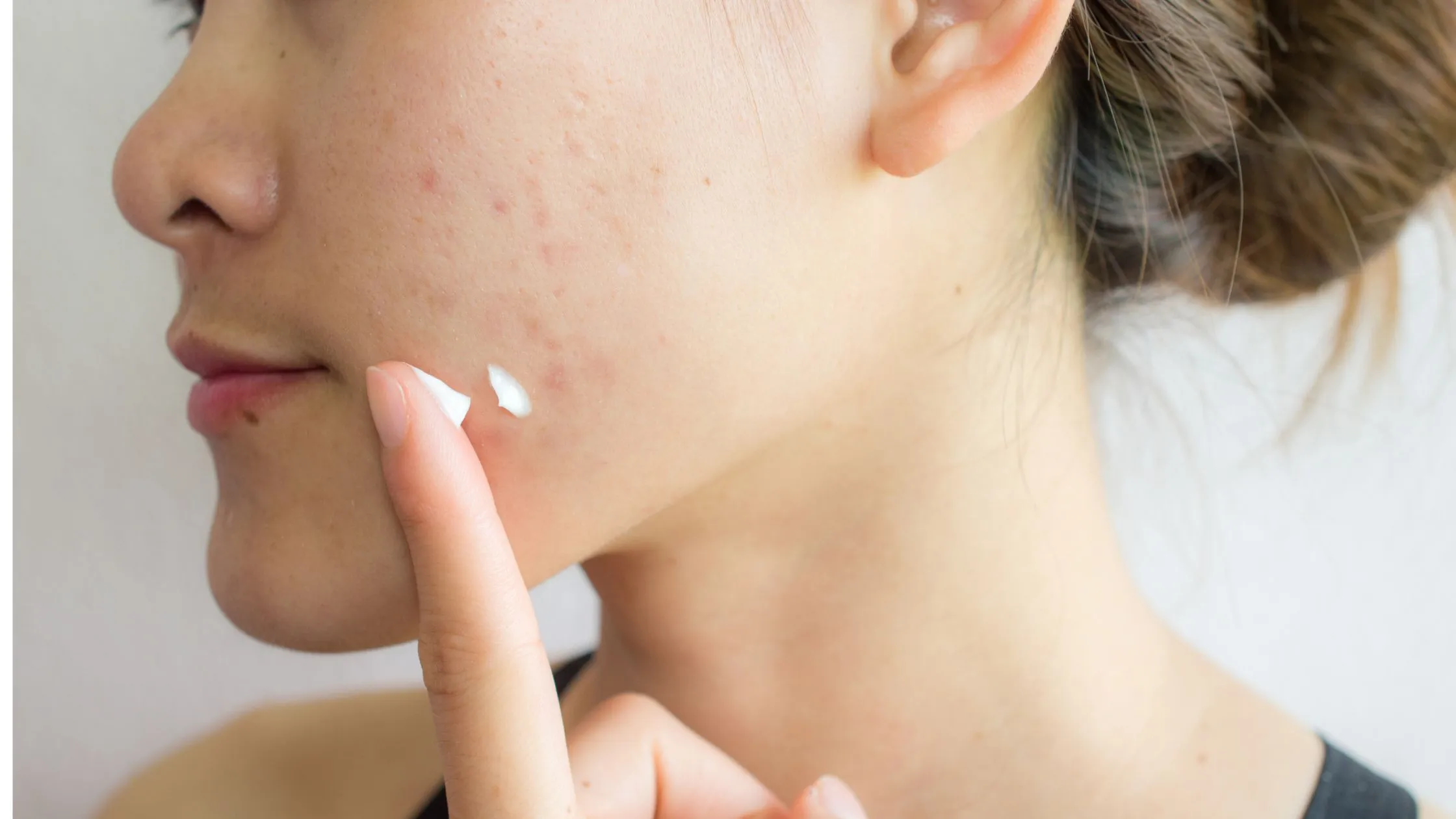 Best Sunscreens for Oily, Acne-Prone Skin: Your Guide