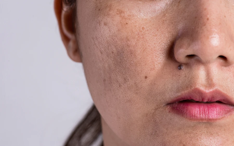 5 Skincare Products for Oily Skin & Blackheads