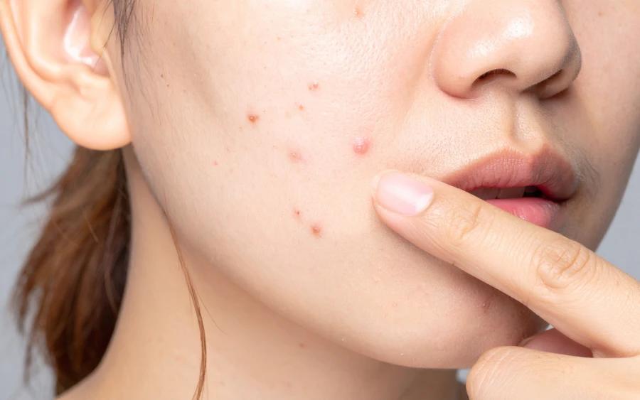 6 Hormonal Acne Causes & Teen Solutions