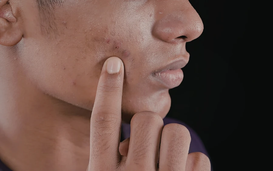 9 Non-Greasy Formulas for Acne-Prone Skin: Control Shine & Breakouts