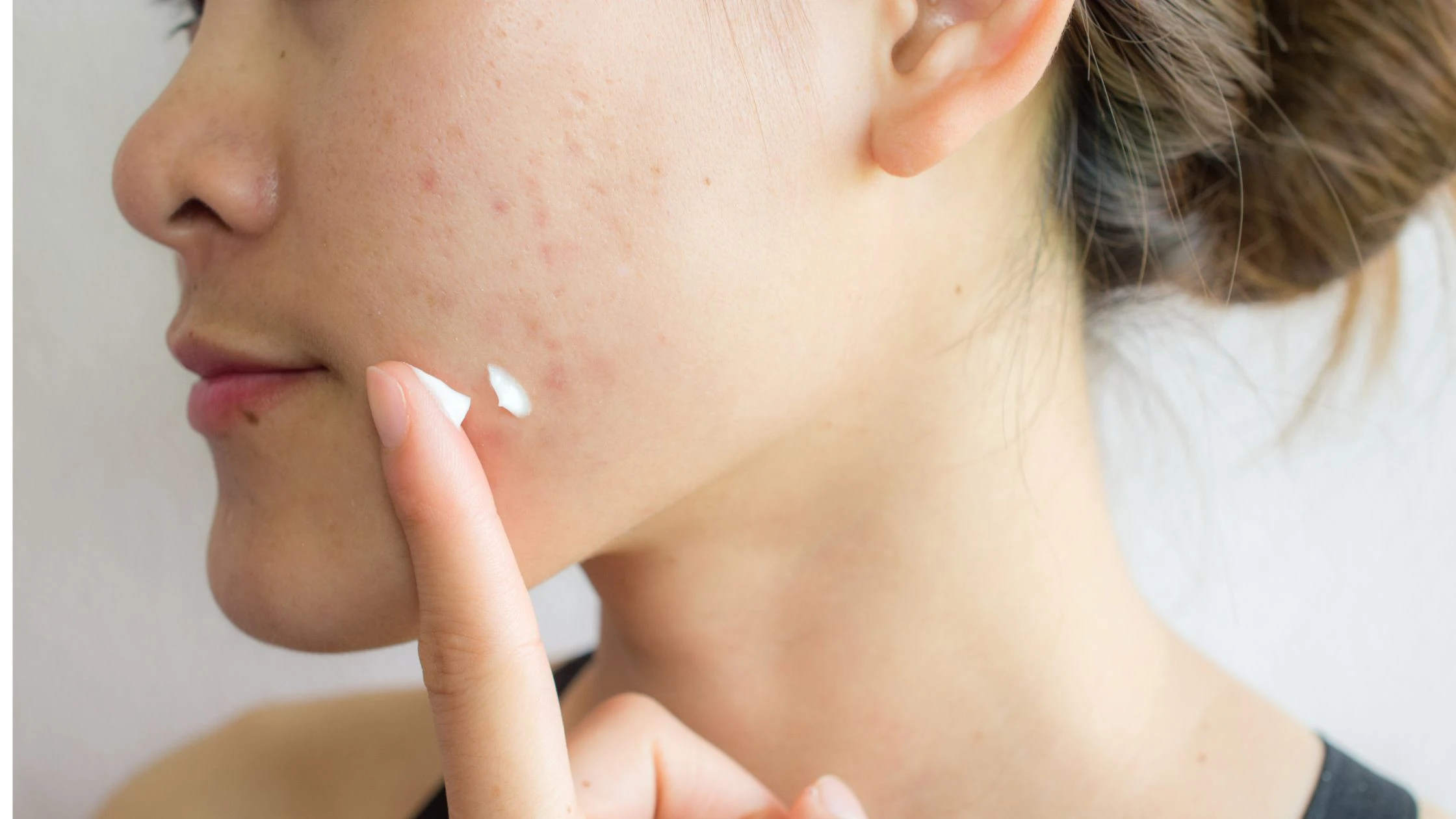Salicylic Acid 101: A Step-by-Step Skin Care Tutorial