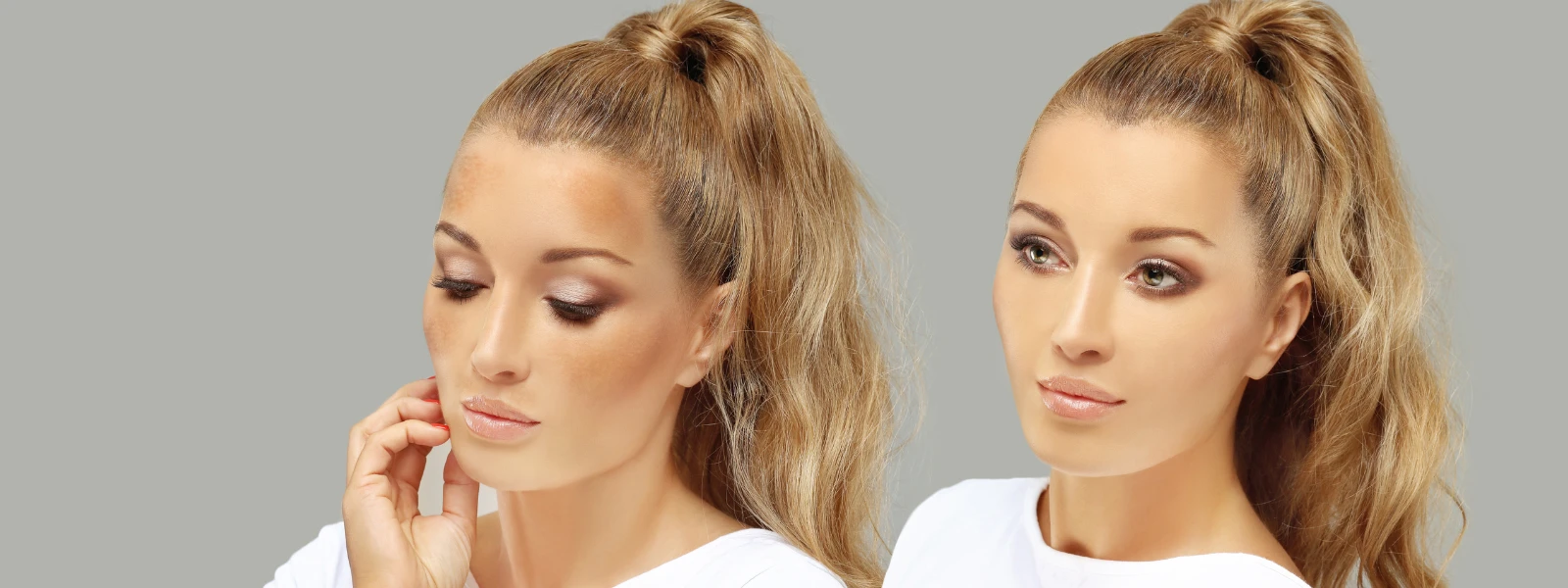 How to Understand Hyperpigmentation Passed Down Through Family