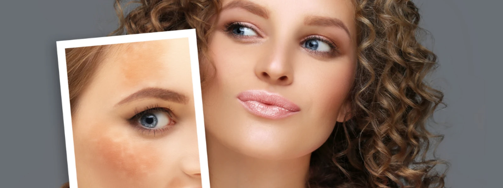 What Causes Hyperpigmentation: Expert Guide