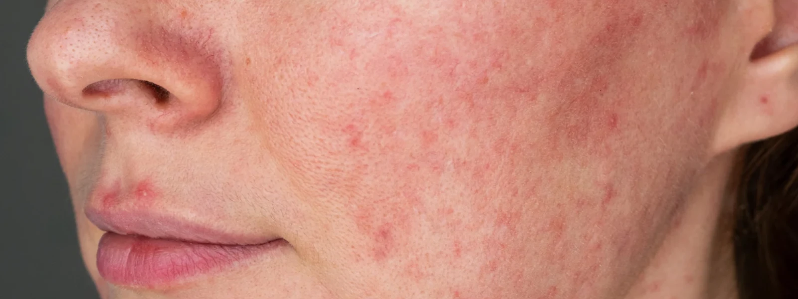 Uncovering the Causes of Facial Pigmentation and How to Treat It