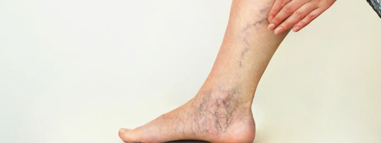 A Step-by-Step Guide to Treating Pigmentation on Legs