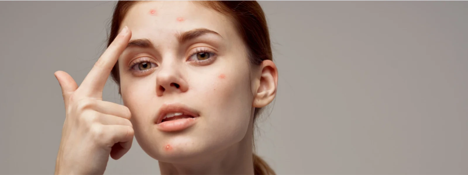Acne 101: Causes, Prevention, and Treatment Guide