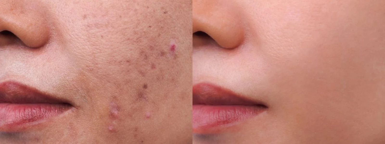 Acne Gone: 5 Salicylic Acid Skincare Picks