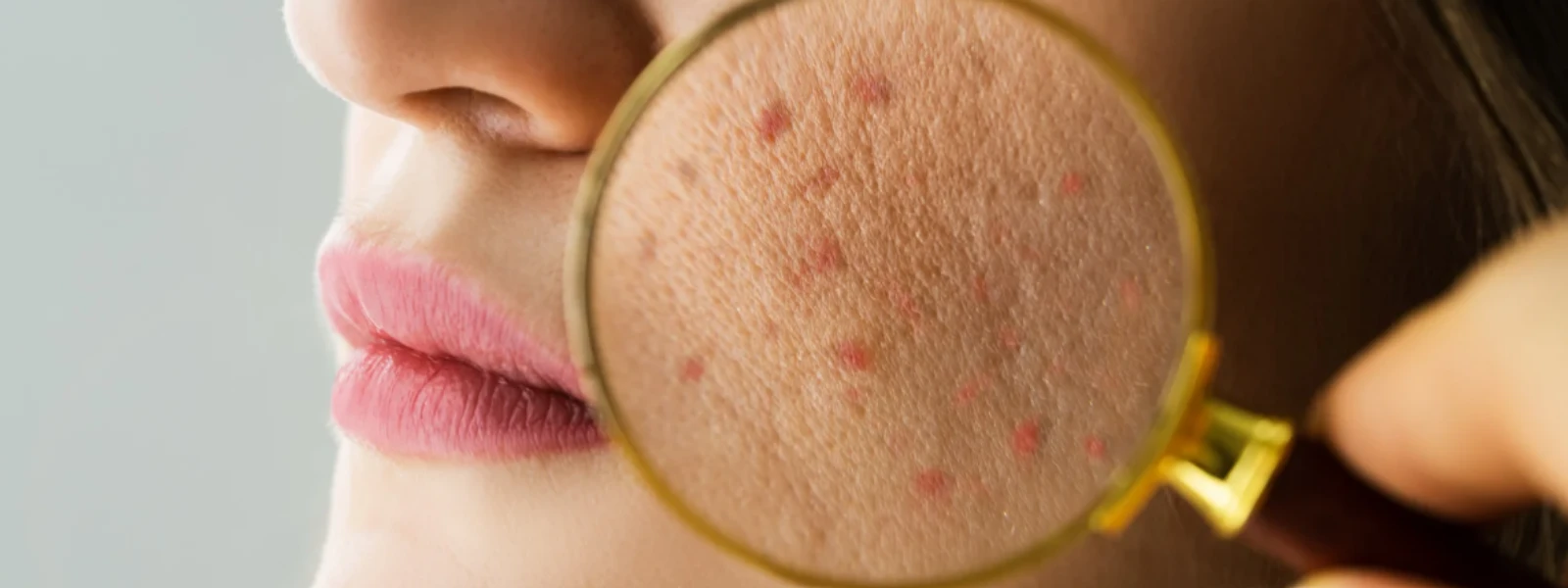 Acne Marks Not Going Away on Sensitive Skin? FAQ Answered