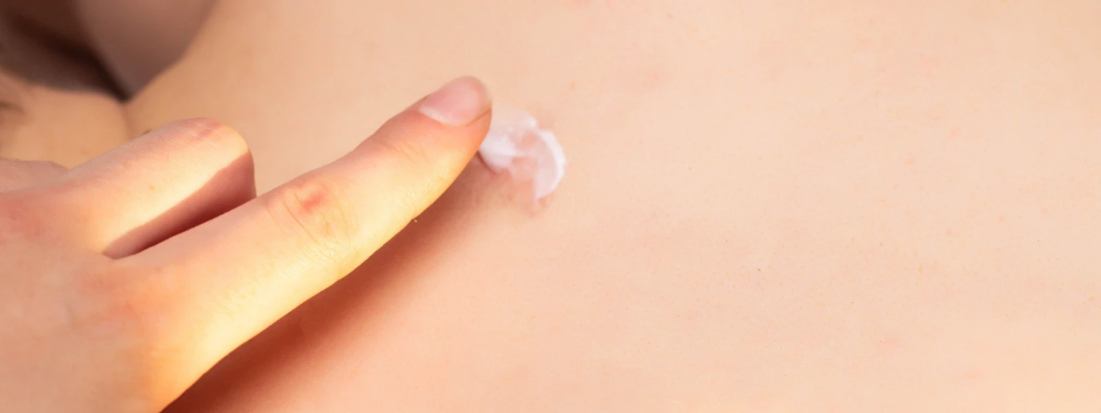 Acne Scar Removal: Expert Tips & Treatment Guide