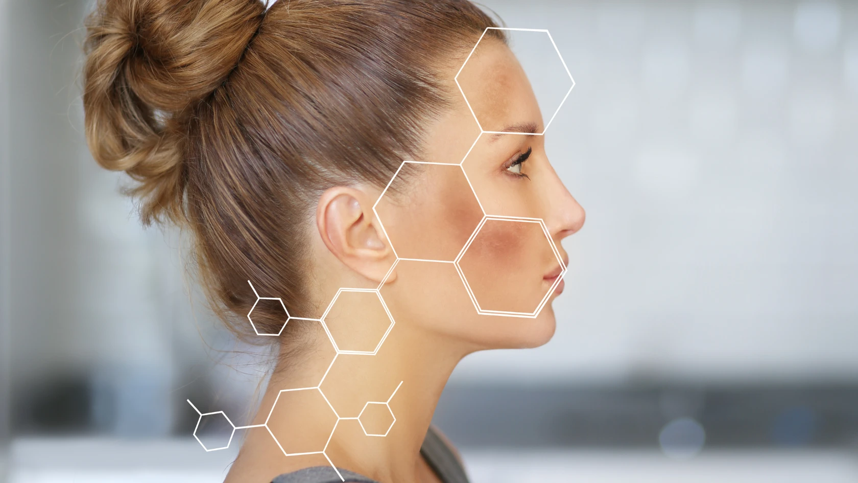 Acne Scars vs PIH FAQ: Differentiating Post-Acne Marks