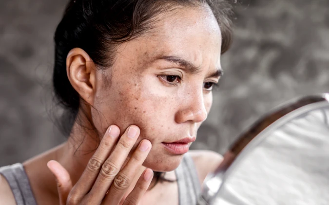 Dark Spots Myths That Mislead: Your FAQ Answered