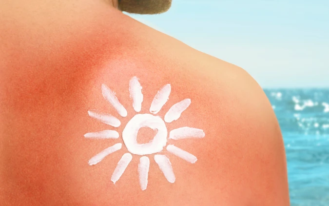 Essential Sun Damage Prevention Tips Checklist