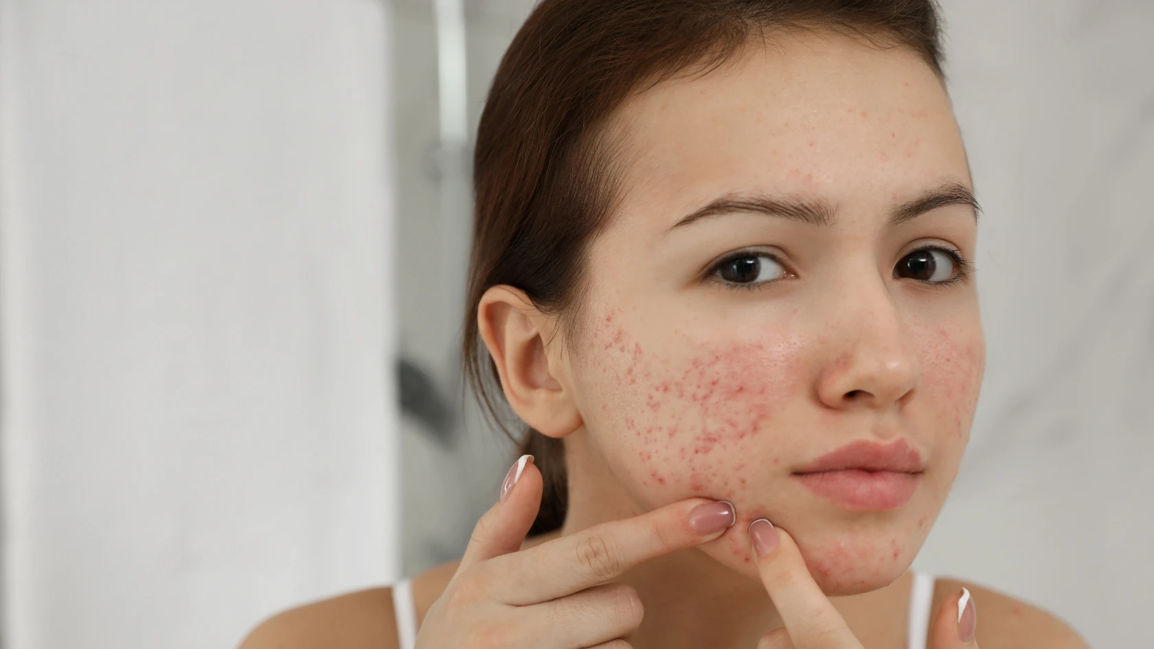 Hormonal Acne vs Regular Acne: Understanding the Difference