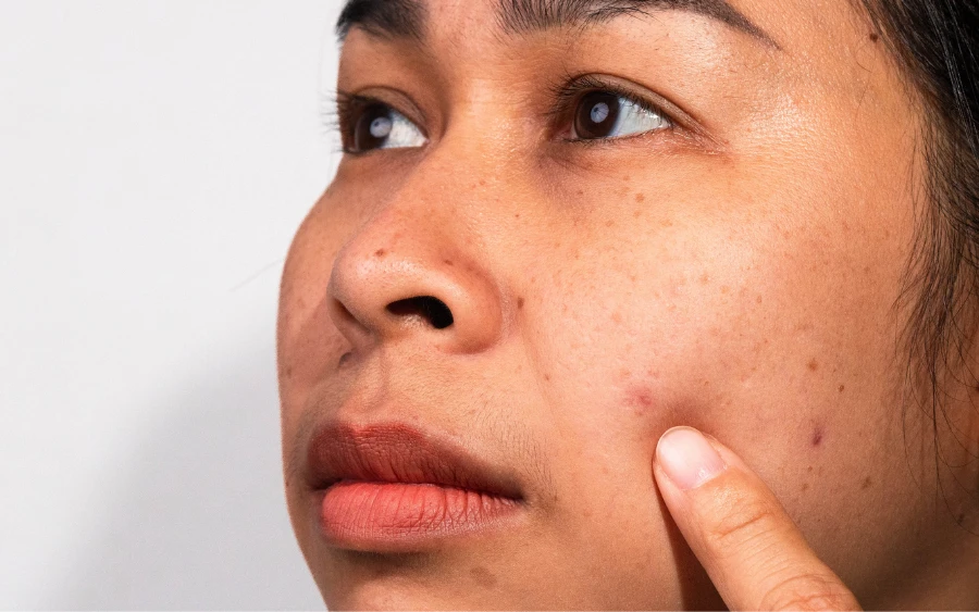 How to Identify Causes of Skin Dark Spots Fast
