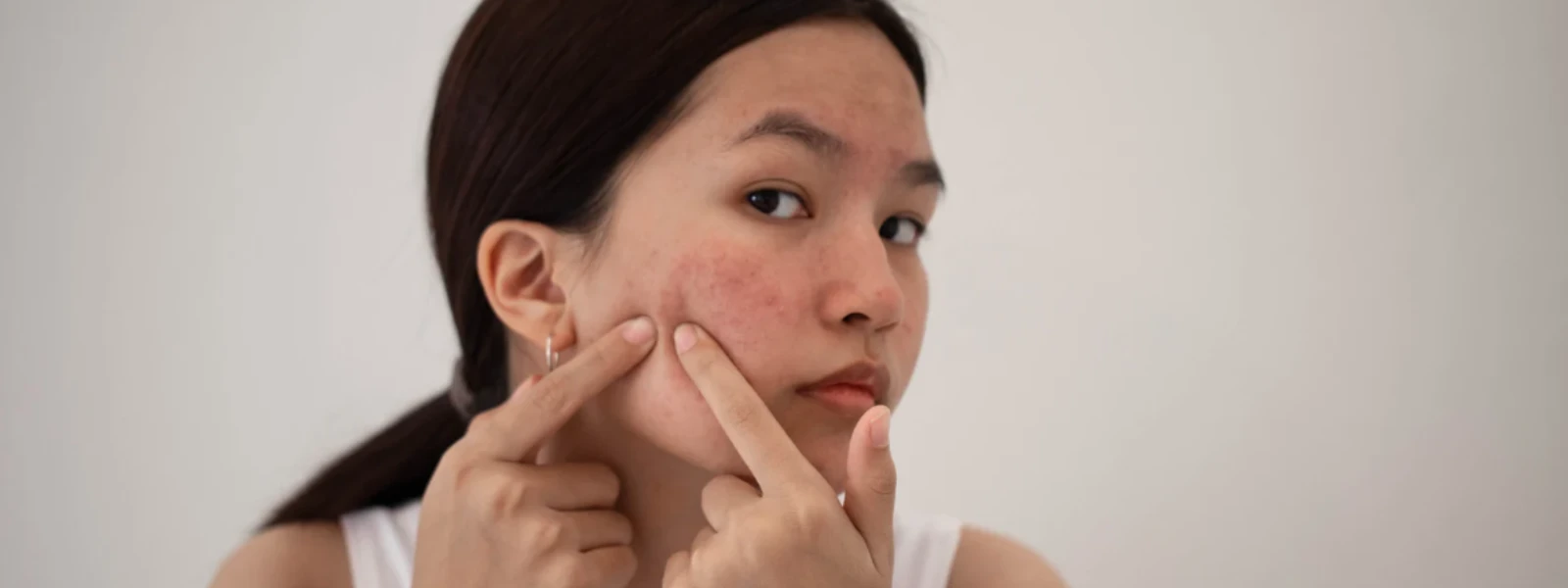 How to Identify Hidden Adult Acne Causes Today