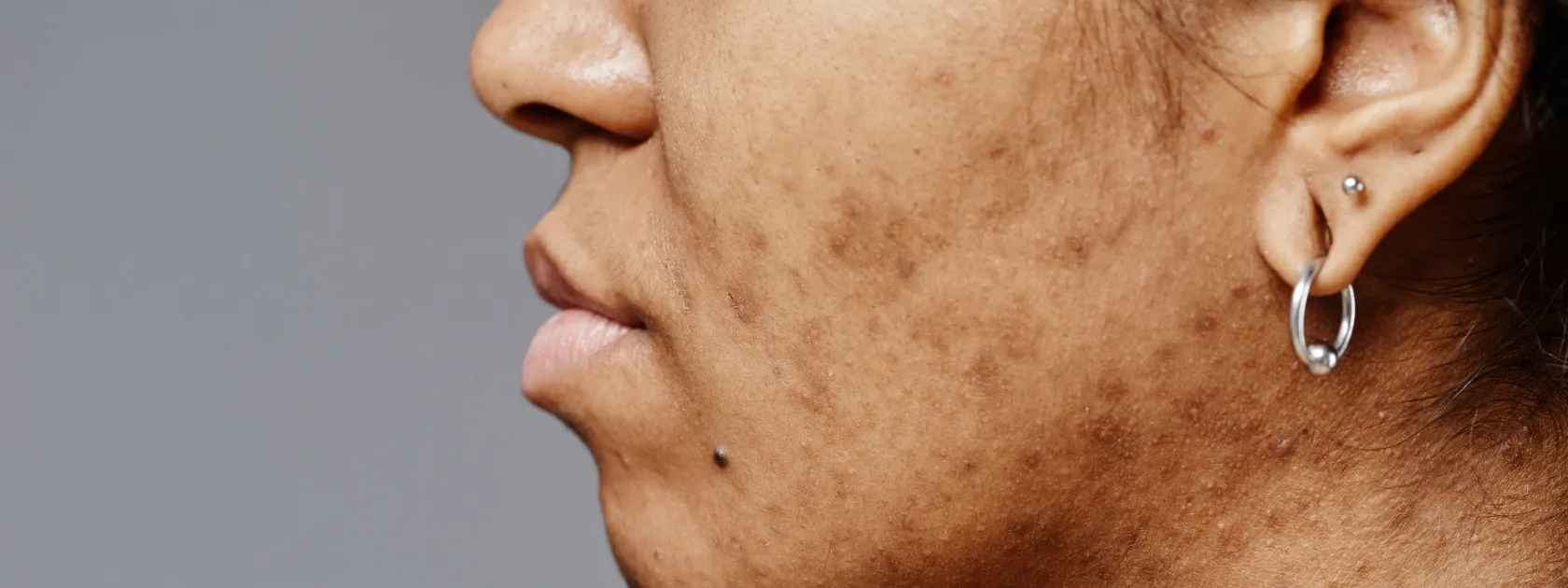 How to Manage Hyperpigmentation Causes: Triggers & Solutions