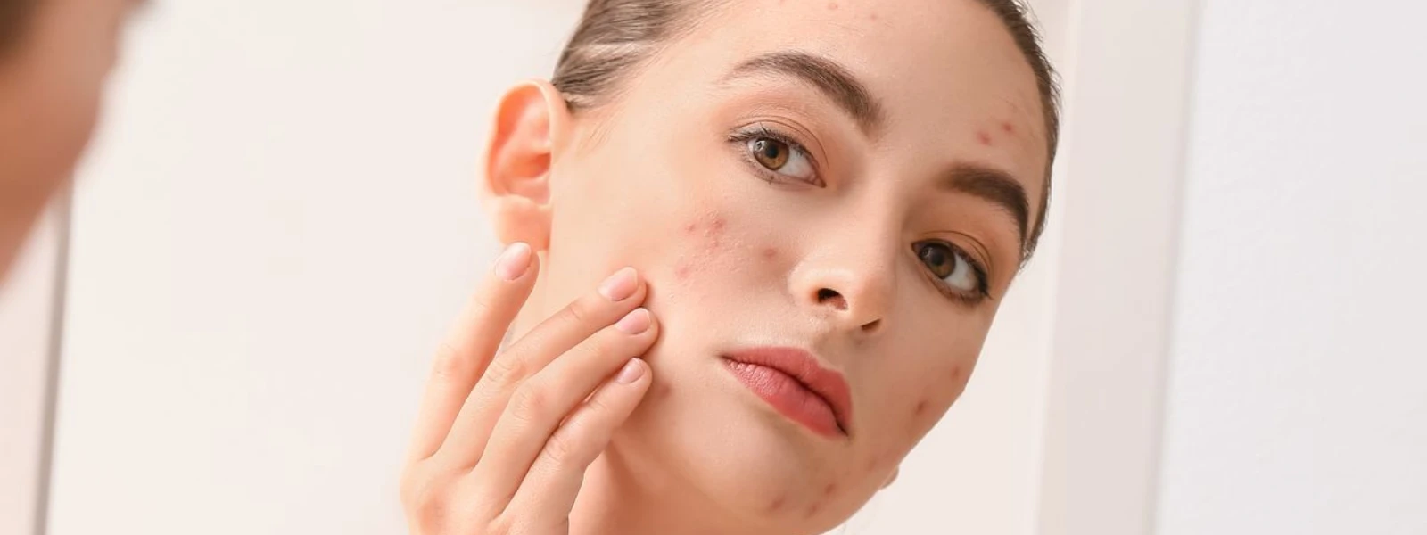 How to Treat Stubborn Acne Effectively: Expert Tips