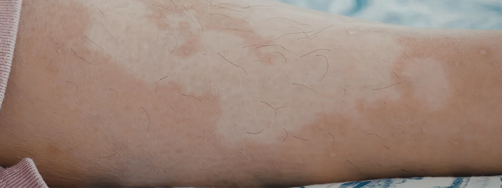 How to Understand Skin Discoloration Causes Effectively