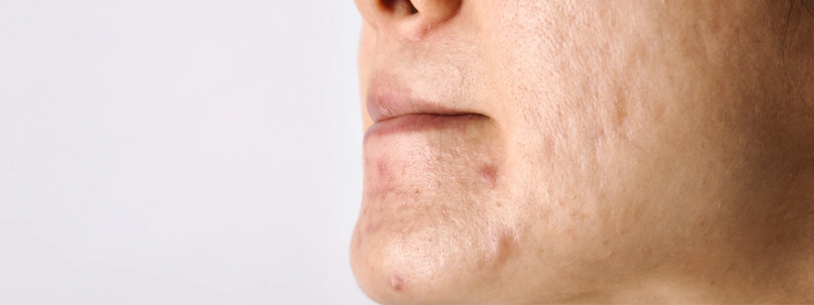 Hyperpigmentation Around Chin: A Step-by-Step Guide to Clearer Skin