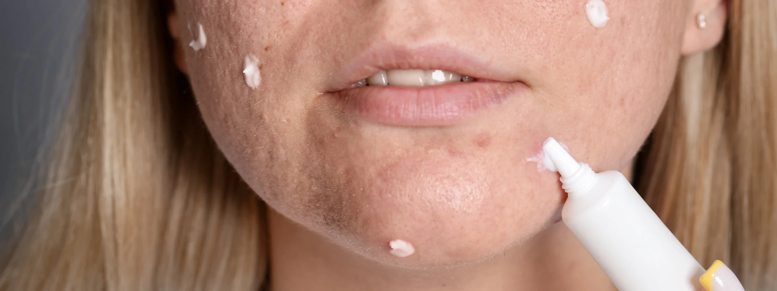 Hyperpigmentation: Natural Fade vs. Professional Care