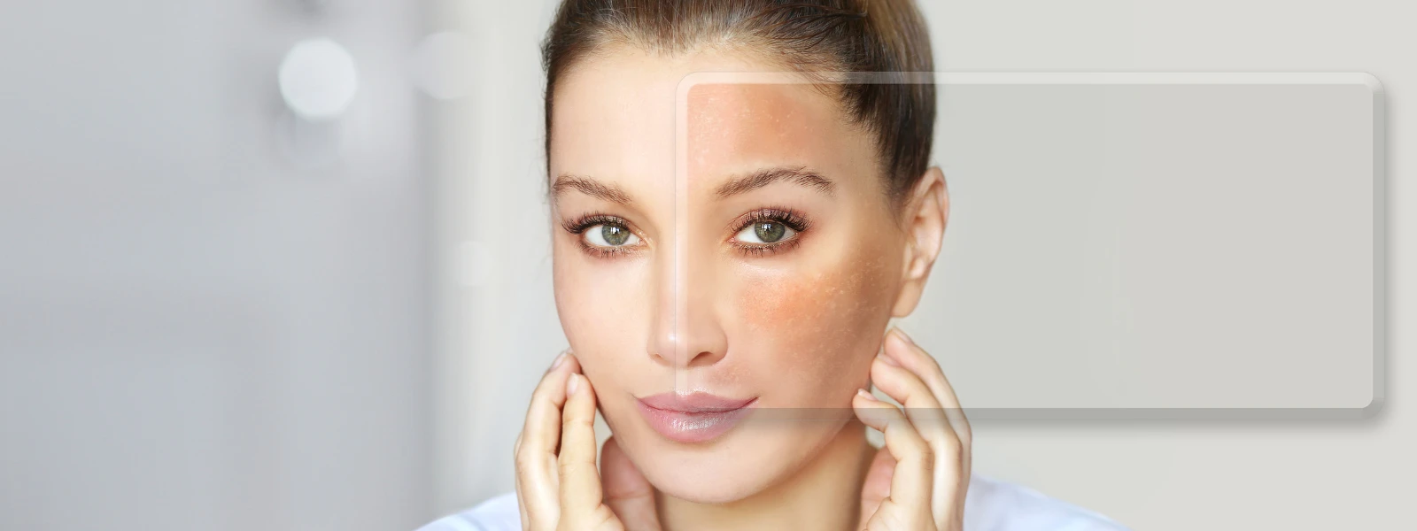 Melasma 101: Everything You Need to Know Now