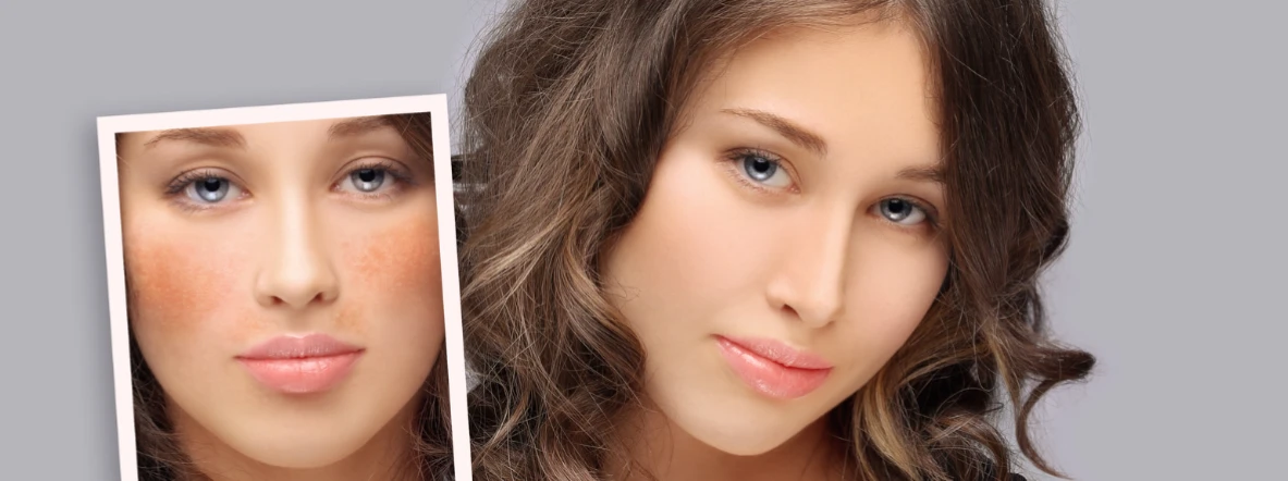 Natural Hyperpigmentation Remedies: Complete Guide