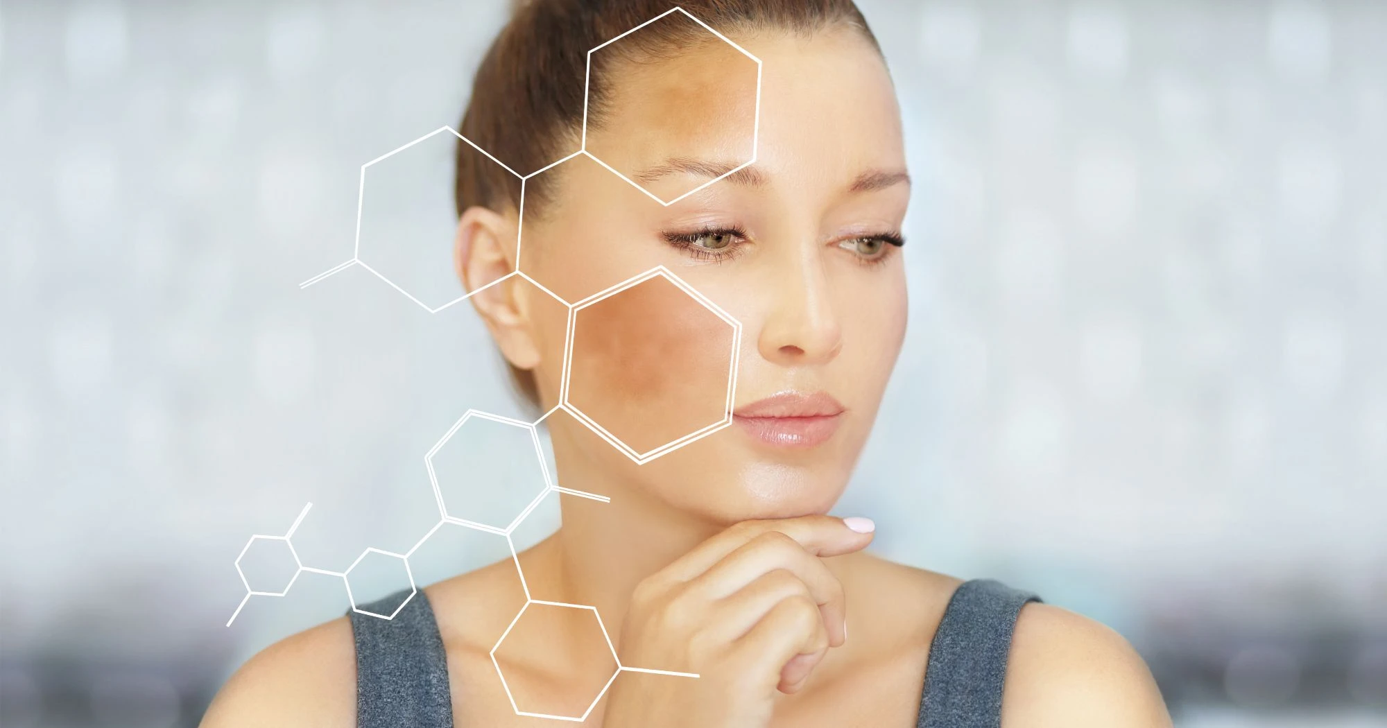Prevent Dark Spots After Acne: Expert Guide