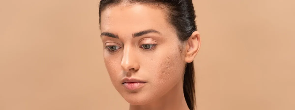 Preventing Future Acne Scars: Complete Guide