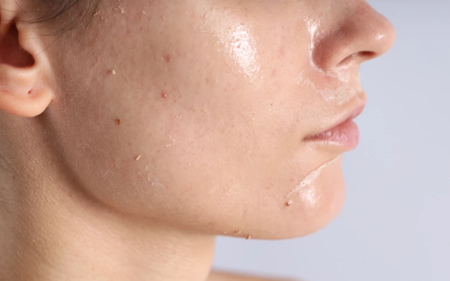 Quick Dry Skin Remedies FAQ: Your Questions Answered
