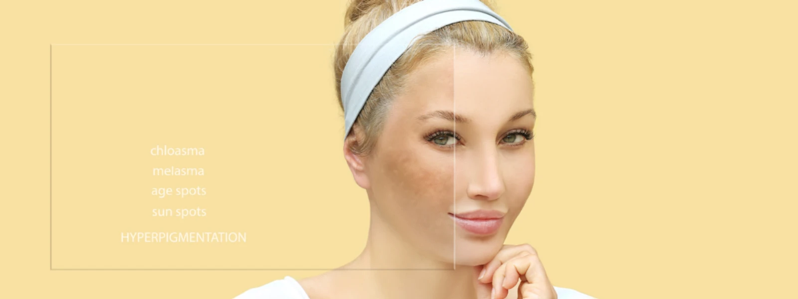 Step-by-Step Guide to Treating Hyperpigmentation on Cheeks