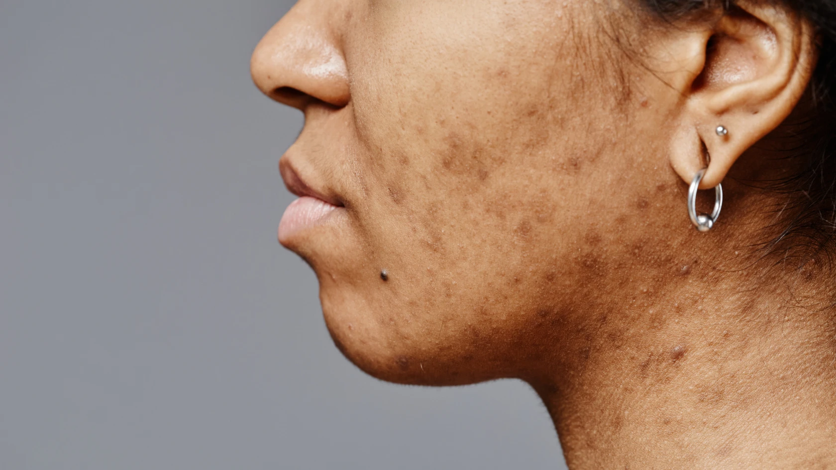 The Right Way to Remove Dark Spots on Melanin-Rich Skin