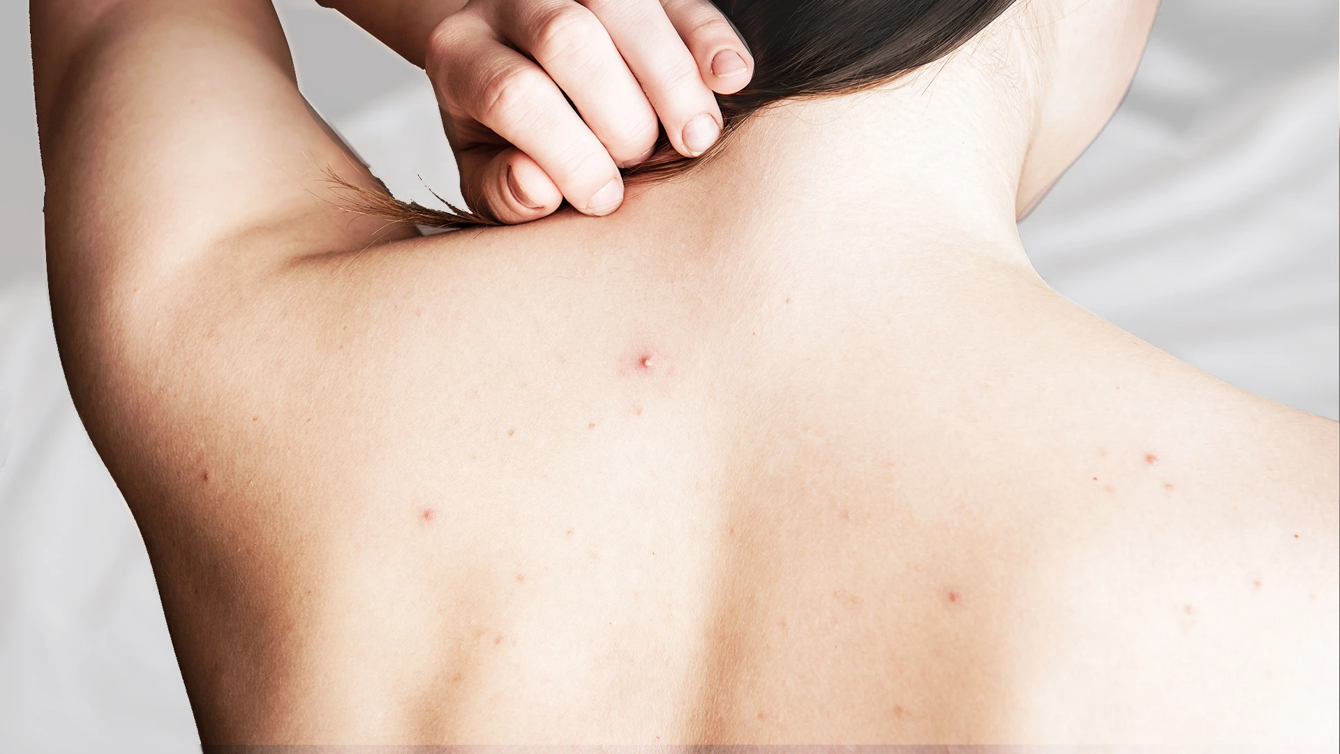 The Ultimate Checklist to Treat Body Acne Marks Effectively