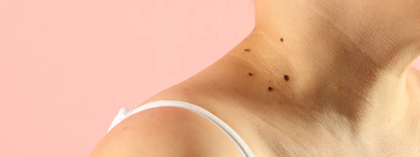 Treat Dark Marks FAQ: Your Guide to Hyperpigmentation Treatment