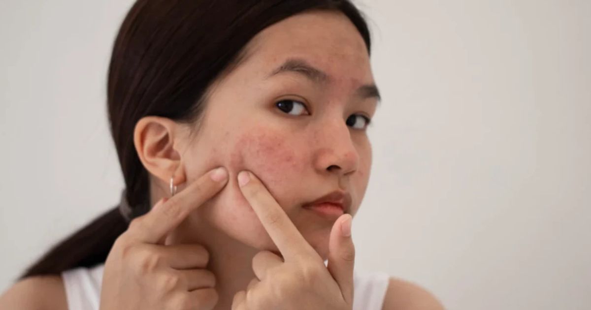 Causes of Dark Spots: A Complete Tutorial on Hyperpigmentation