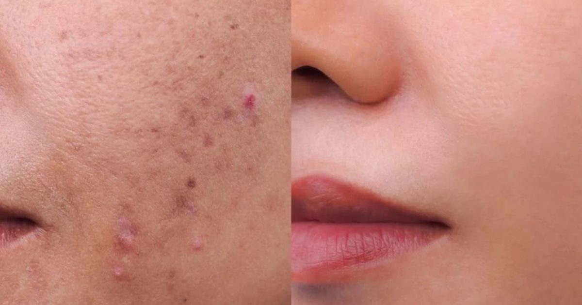 How to Layer Actives for PIH on Indian Skin Effectively