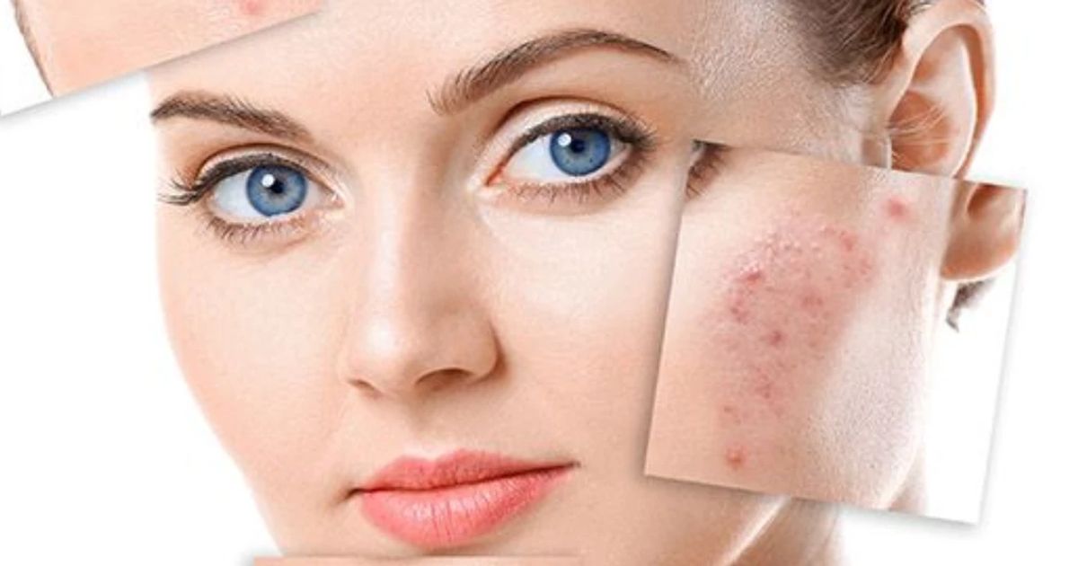 Hyperpigmentation FAQ: Understanding Skin Discoloration Causes