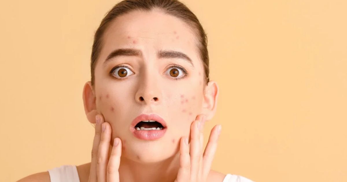 What Causes Dark Spots? Your FAQ Answered