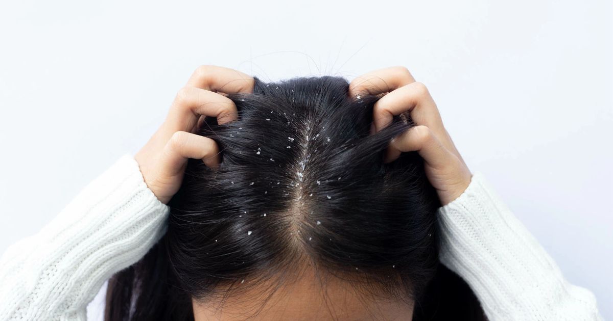 Rimedi naturali ed efficaci per eliminare la forfora a casa rapidamente.